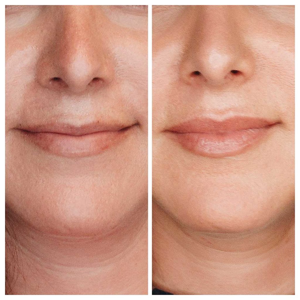 Botox for Lip Flip Before & After | New U Women's Clinic & Aesthetics in Kennewick, WA
