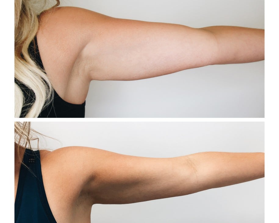 EVOLVE TITE Arms Before & After | New U Women's Clinic & Aesthetics in Kennewick, WA