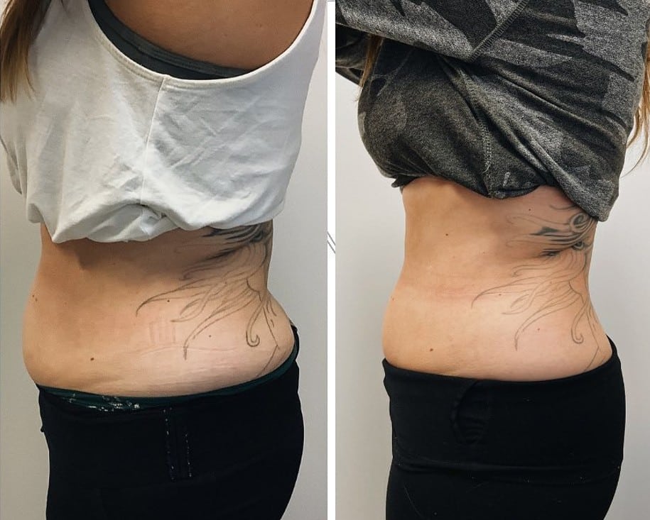 EVOLVE Tite Abdomen Before & After | New U Women's Clinic & Aesthetics in Kennewick, WA