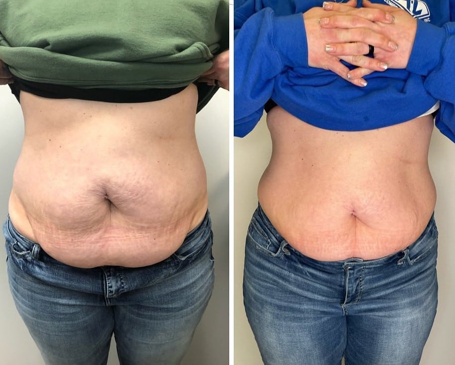 EVOLVE Tite Abdomen Before & After | New U Women's Clinic & Aesthetics in Kennewick, WA