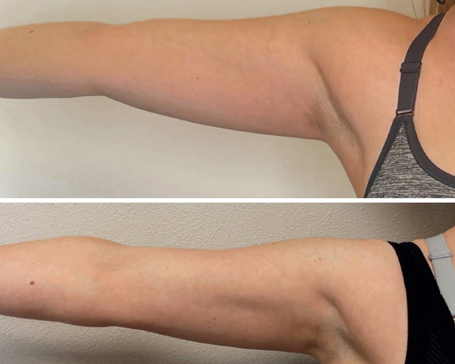 EVOLVE Tite Arms Before & After | New U Women's Clinic & Aesthetics in Kennewick, WA