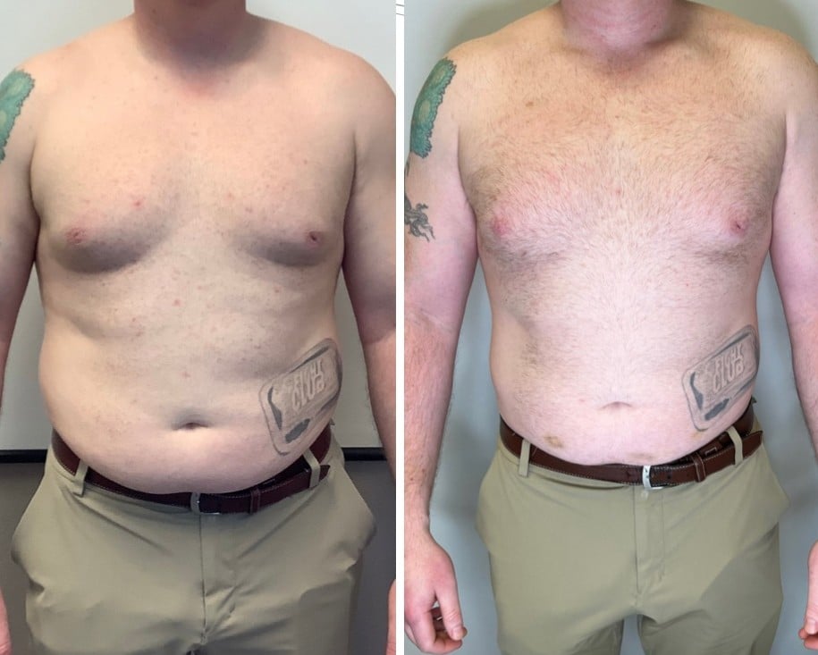EVOLVE Tone Abs Before & After | New U Women's Clinic & Aesthetics in Kennewick, WA