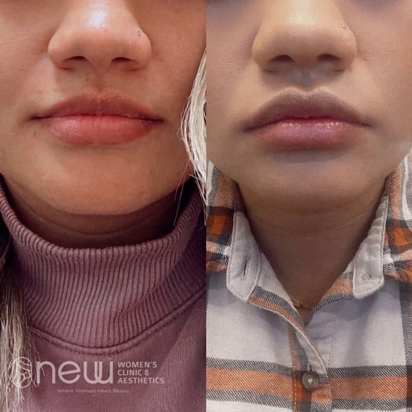 Juvederm Lip Filler Before & After | New U Women's Clinic & Aesthetics in Kennewick, WA
