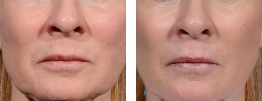Morpheus8 Treatment on Lips and Face Before & After | New U Women's Clinic & Aesthetics in Kennewick, WA