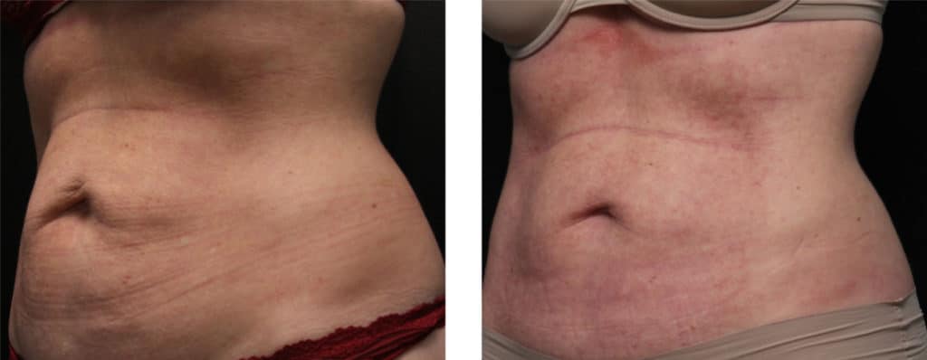Morpheus8 Treatment on Stomach Before & After | New U Women's Clinic & Aesthetics in Kennewick, WA