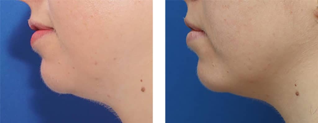 Morpheus8 For Face Before & After Photos | New U Women's Clinic & Aesthetics in Kennewick, WA