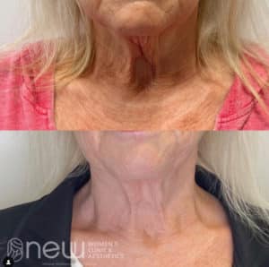 MINT PDO Threads Before & After | New U Women's Clinic & Aesthetics in Kennewick, WA