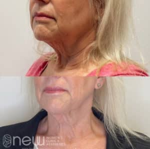 MINT PDO Threads Before & After | New U Women's Clinic & Aesthetics in Kennewick, WA