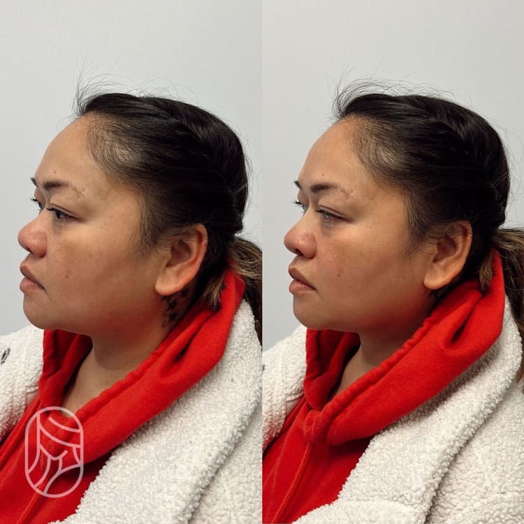 Nonsurgical Rhinoplasty with MINT Before & After | New U Women's Clinic & Aesthetics in Kennewick, WA