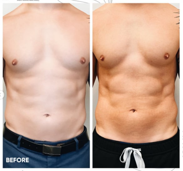 Evolve men abs ​​​​​​​​Before and After Photos | New U Women's Clinic & Aesthetics in Kennewick, WA