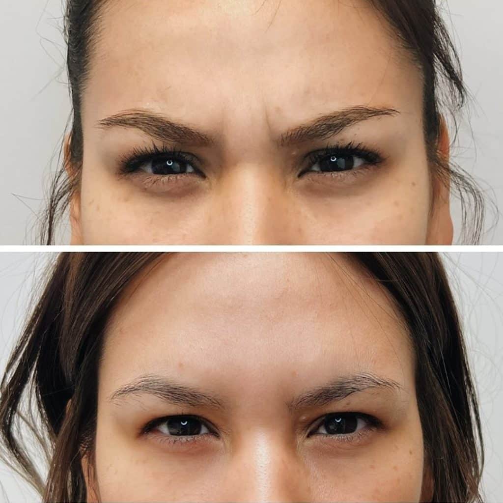 Jeuveau Glabella injection Before & After | New U Women's Clinic & Aesthetics in Kennewick, WA