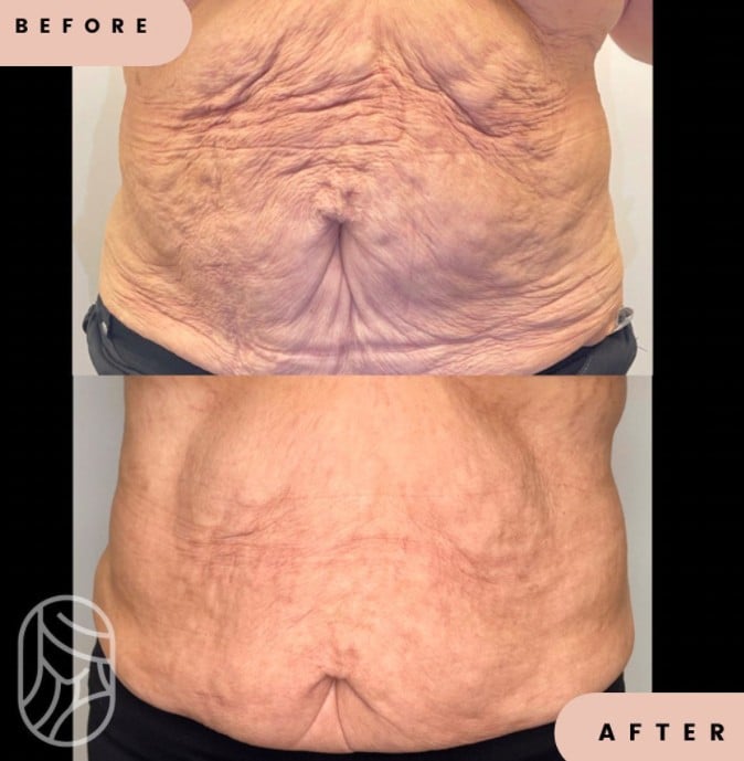 Morpheus8 For Stomach Before & After Treatment | New U Women's Clinic & Aesthetics in Kennewick, WA