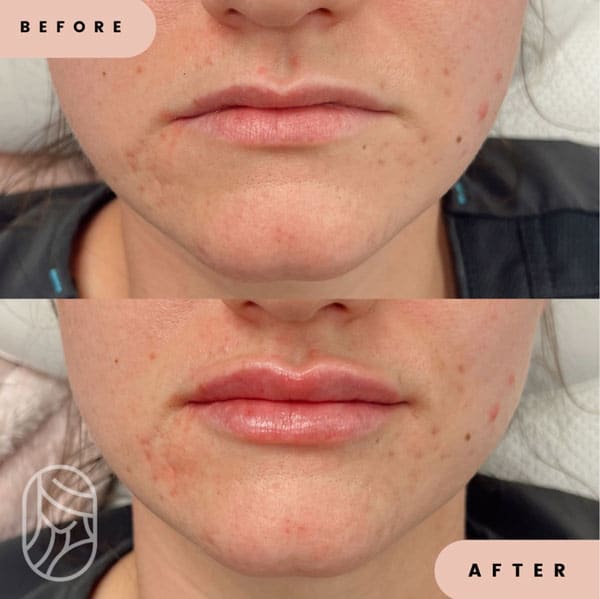 Lip Filler Before & After Photos | New U Women's Clinic & Aesthetics in Kennewick, WA