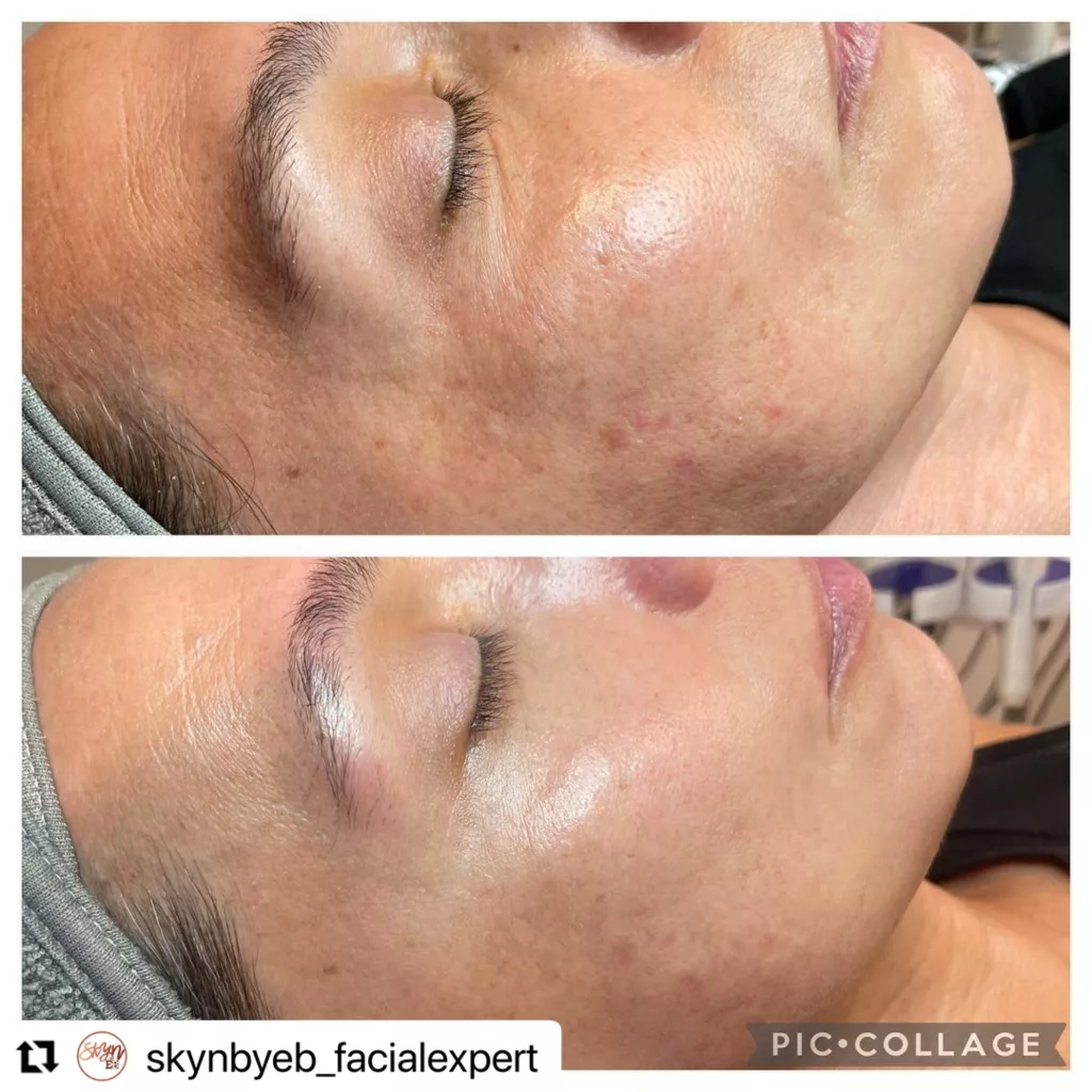 Chemical Peels Before and After Treatment Photos | New U Women's Clinic & Aesthetics in Kennewick, WA