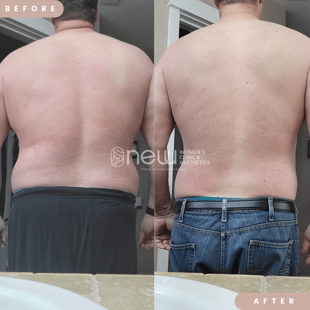 Before and After treatment result | New U Women's Clinic & Aesthetics in Kennewick, WA
