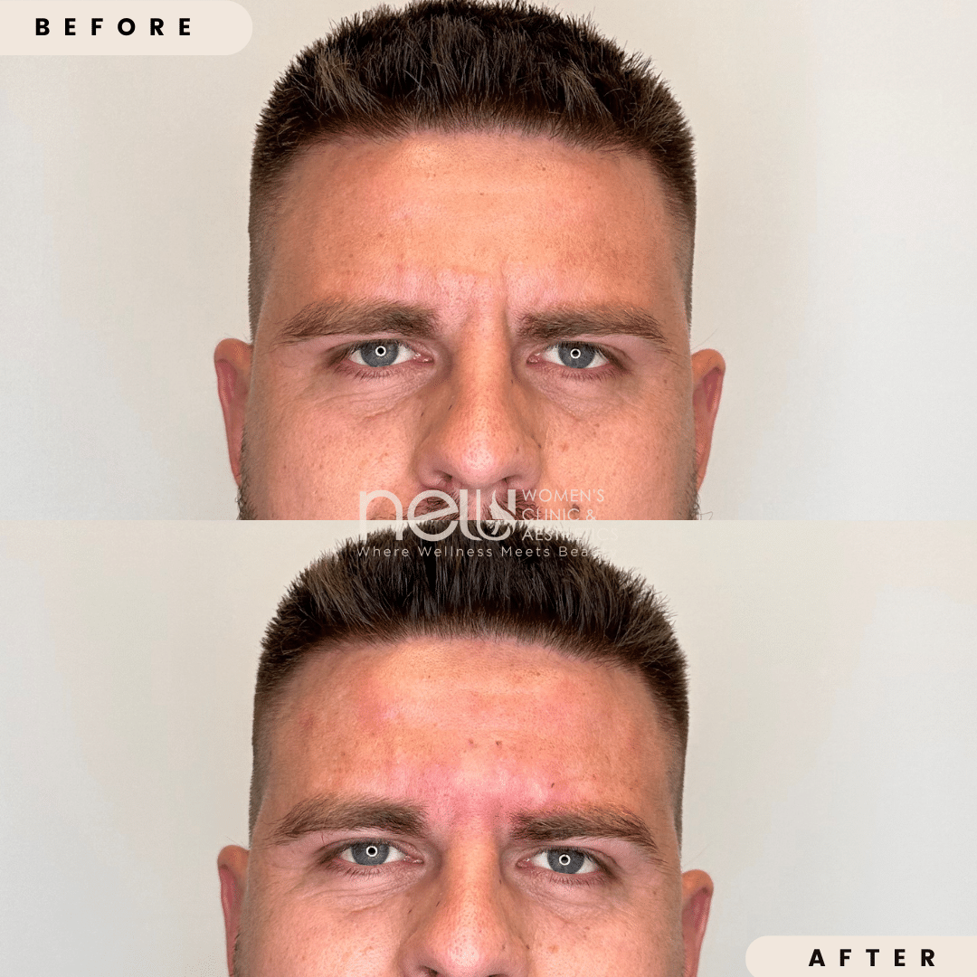 Before and After treatment results | New U Women's Clinic & Aesthetics in Kennewick, WA