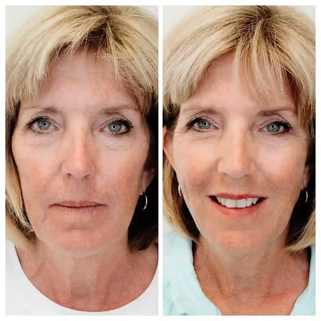 Before-and-After-MINT-PDO - New U Women's Clinic & Aesthetics