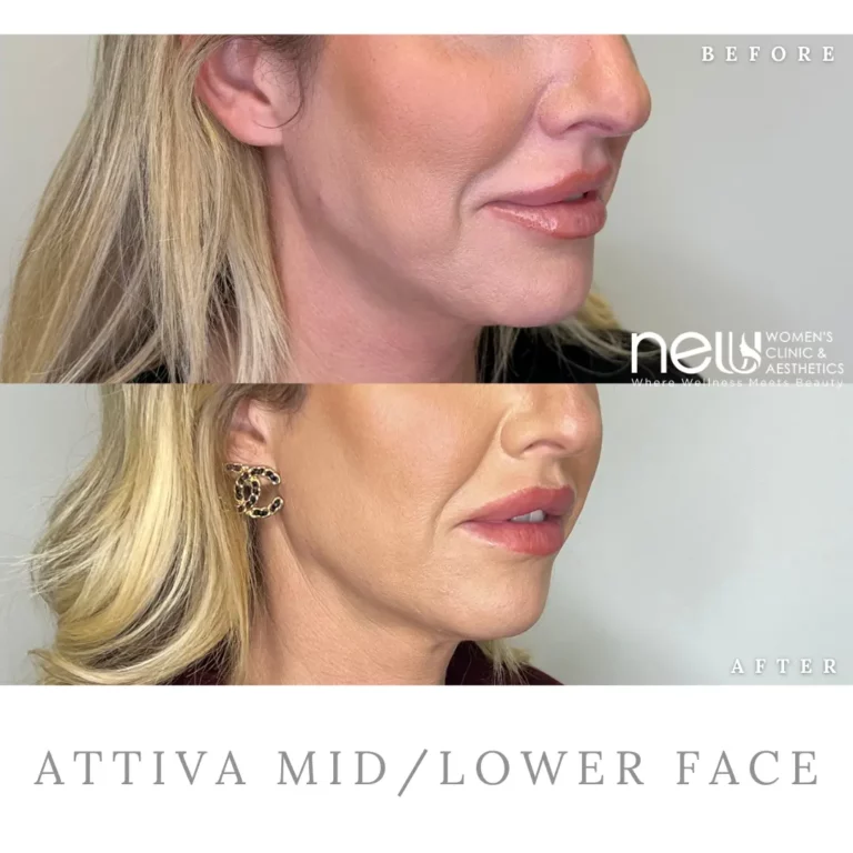 a woman with blonde hair before and after her lip surgery