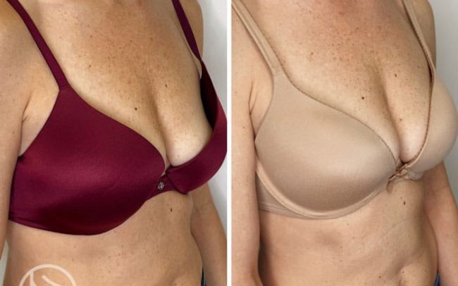 Vampire Breast with MINT Sutures Before & After | New U Women's Clinic & Aesthetics in Kennewick, WA