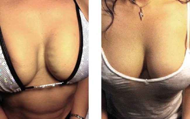 Breast Lift Before & After | New U Women's Clinic & Aesthetics in Kennewick, WA