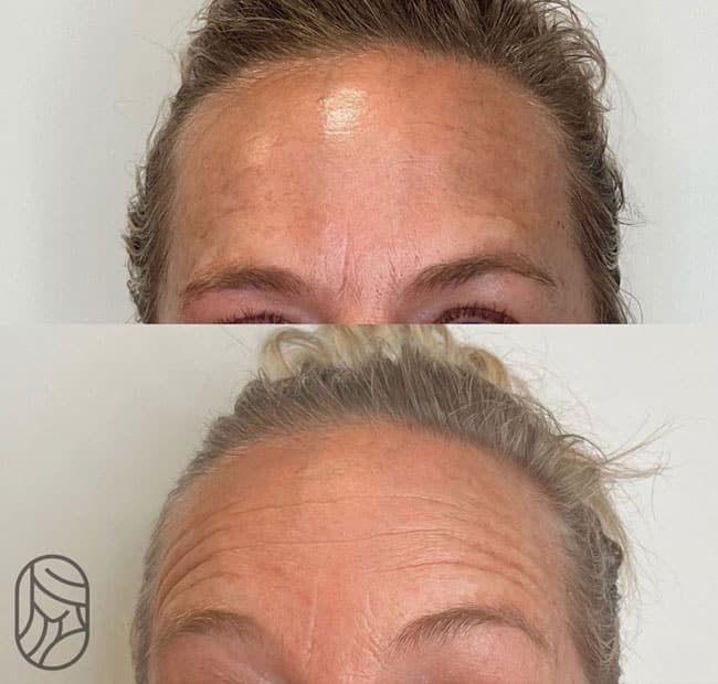 Before-and-After BOTOX forehead