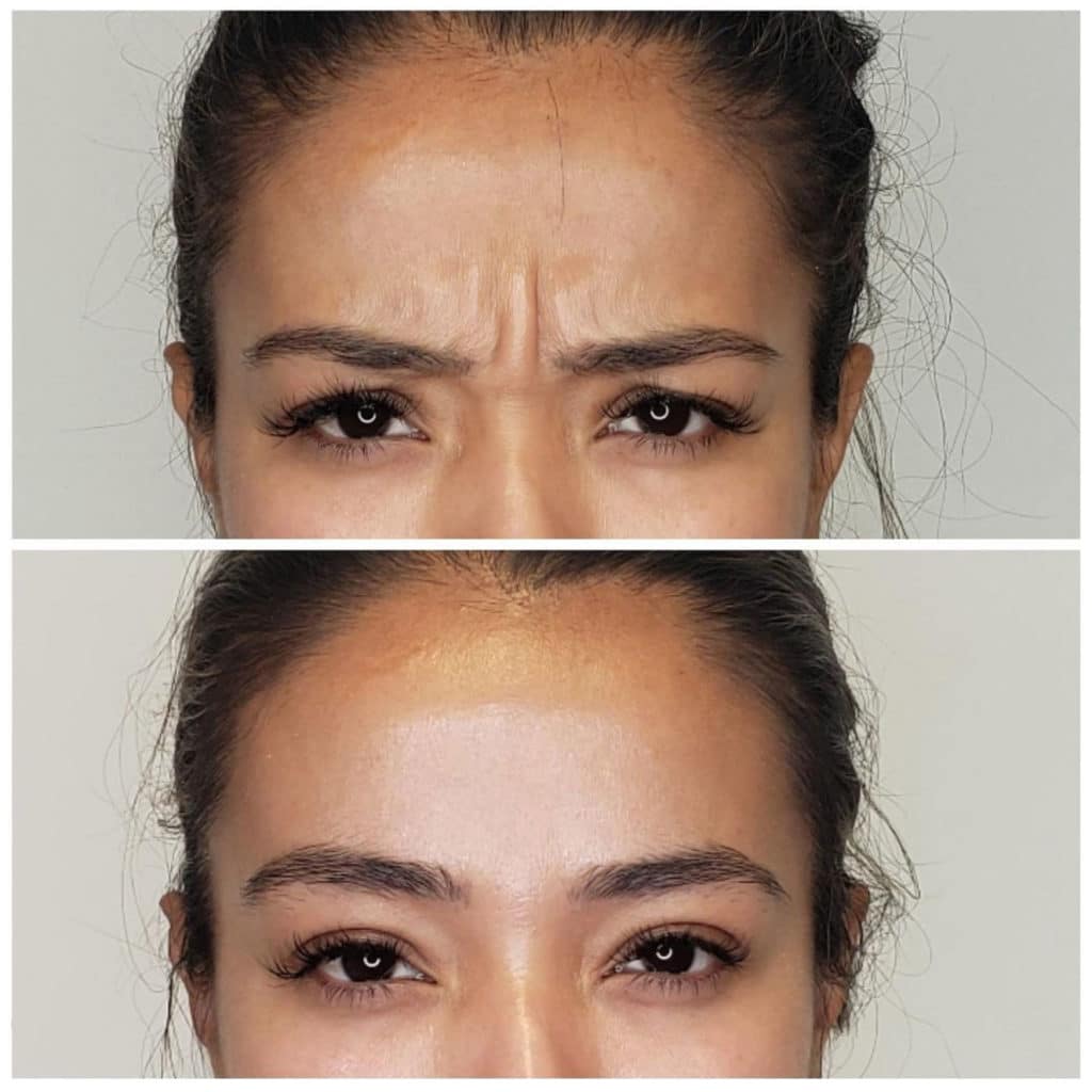 Botox- forehead lines before-after