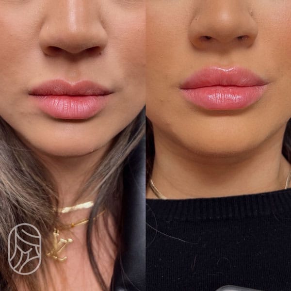 Juvederm-lip-filler-before-and-afters