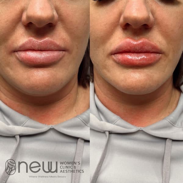 Juvederm Lip Filler Before & After | New U Women's Clinic & Aesthetics in Kennewick, WA