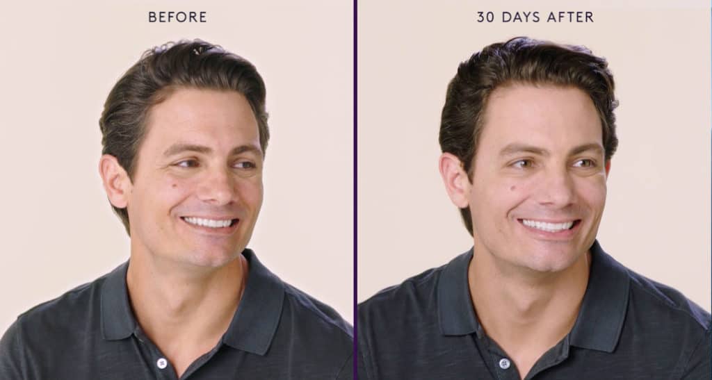 Botox for Men Before & After | New U Women's Clinic & Aesthetics in Kennewick, WA
