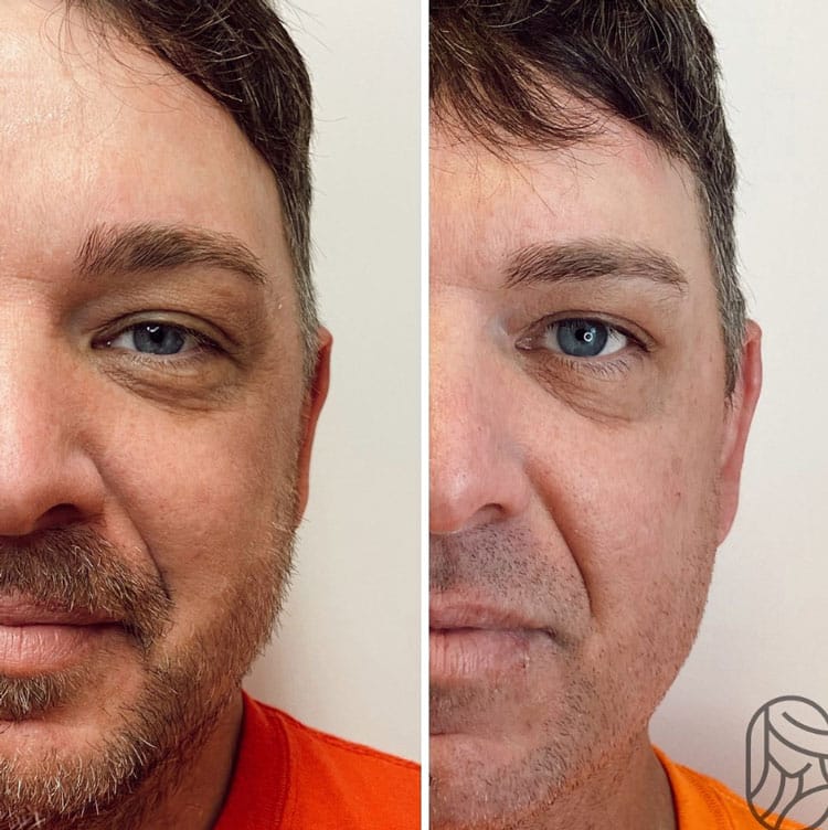 Platelet Rich Plasma PRP eye-face before and after