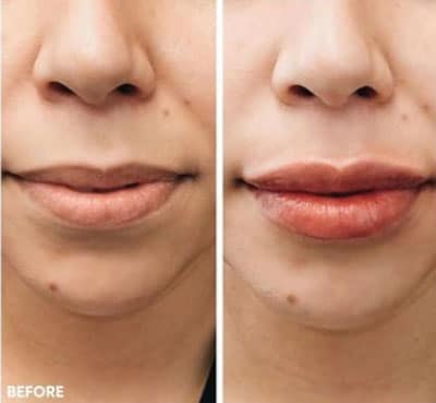 injectables and fillers for lips