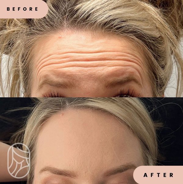 injectables and fillers for forehead lines