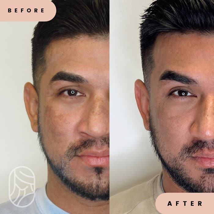 Men Natural Growth Factor Injections Vampire Facelift Before & After | New U Women's Clinic & Aesthetics in Kennewick, WA