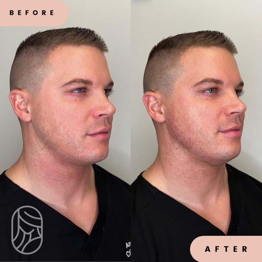 Jawline Skin-tightening ​​​​​​​​Before and After Photos | New U Women's Clinic & Aesthetics in Kennewick, WA