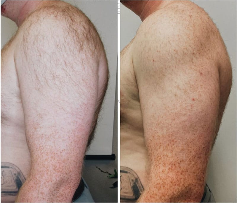 Evolve-tone-prp-muscle-injections Before and After Treatment Photos | New U Women's Clinic & Aesthetics in Kennewick, WA