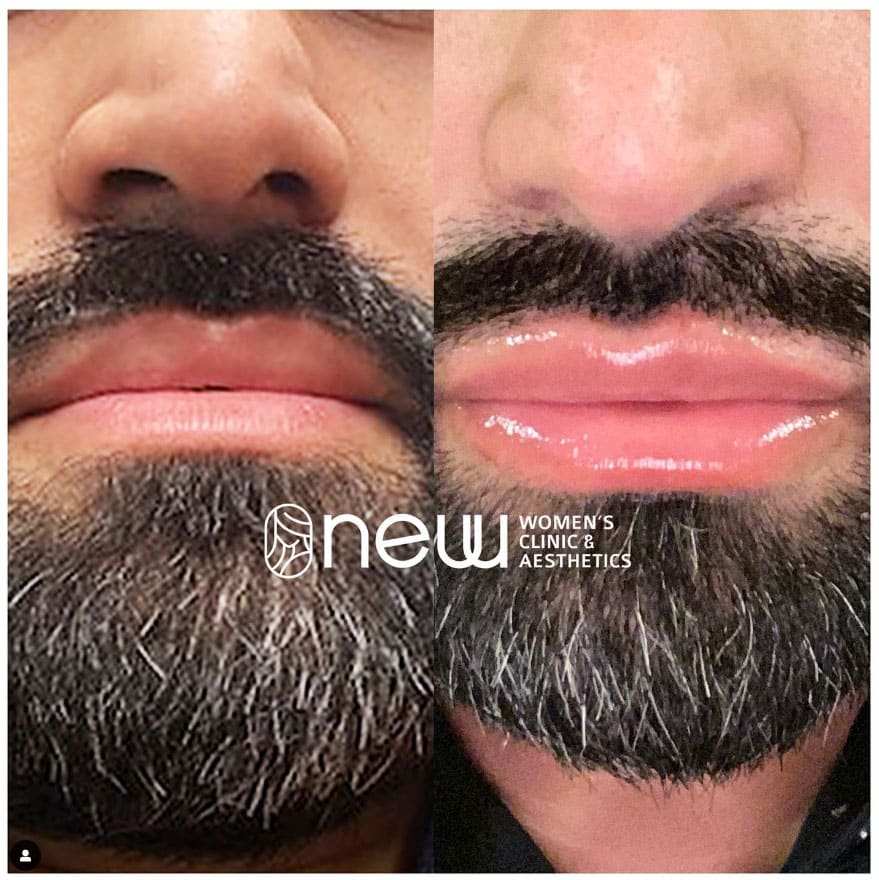 Juvederm men lips Before and After Treatment Photos | New U Women's Clinic & Aesthetics in Kennewick, WA