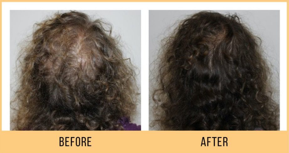 keravive hair treatment before after images