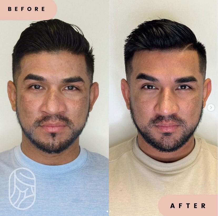 Vampire Facial Before and After Treatment Photos | New U Women's Clinic & Aesthetics in Kennewick, WA