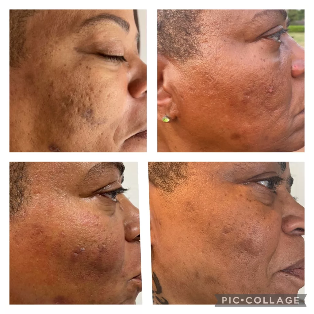 Chemical Peels Before and After Treatment Photos | New U Women's Clinic & Aesthetics in Kennewick, WA