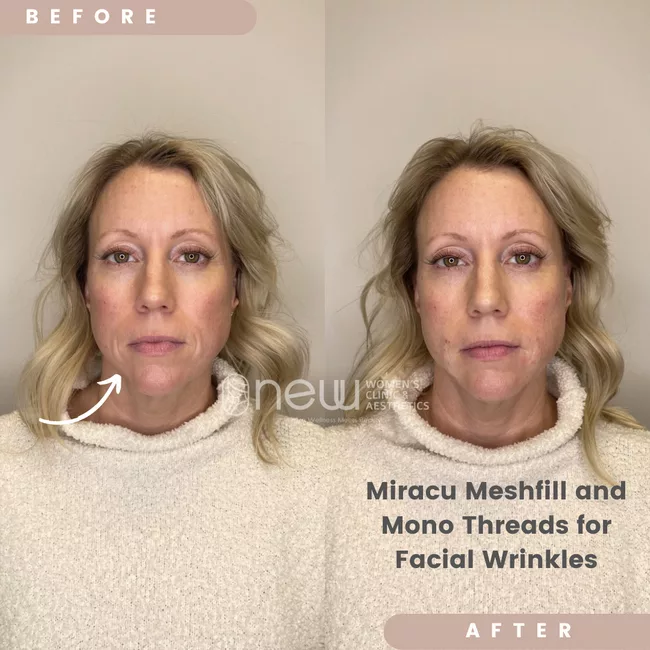 Miracu meshfill before and after PDO Threads photos | New U Women's Clinic & Aesthetics in Kennewick, WA