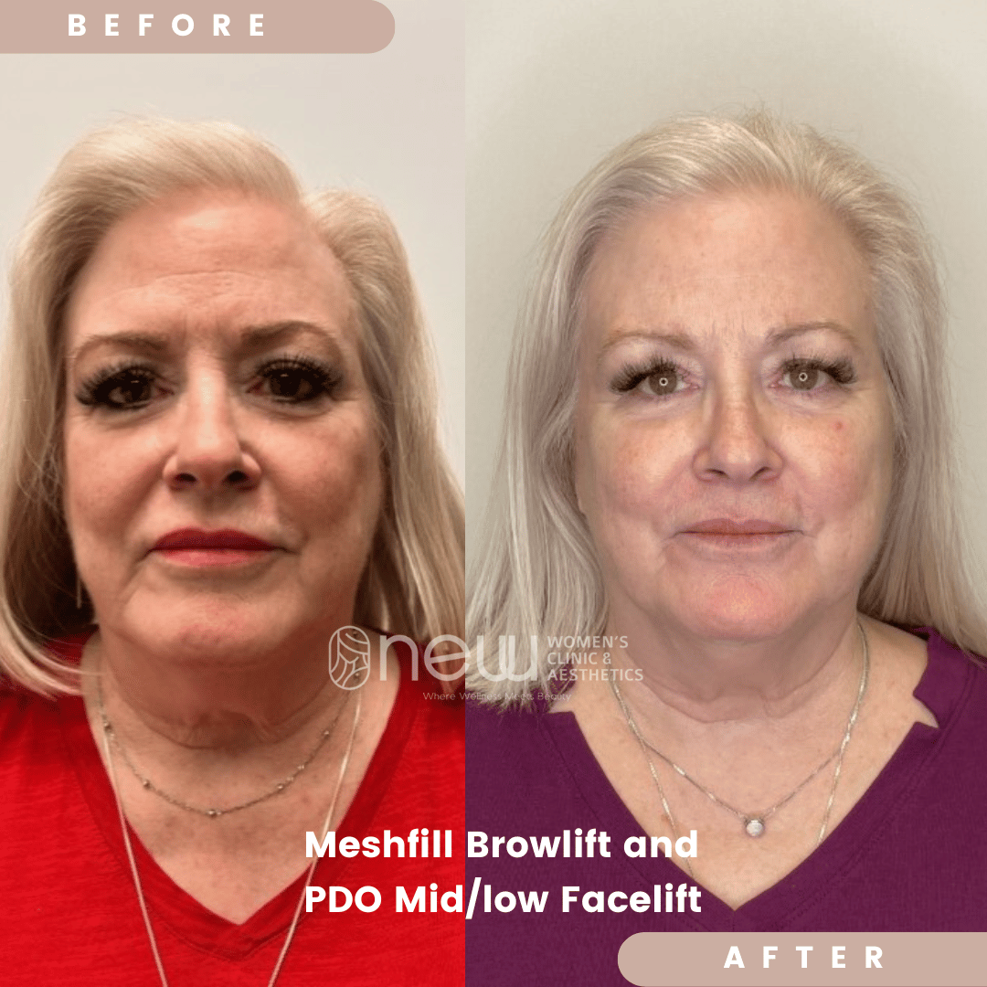 Pdo-meshfil before and after treatment photos | New U Women's Clinic & Aesthetics in Kennewick, WA
